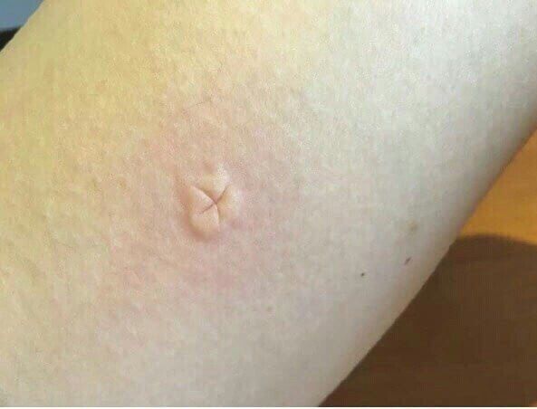 Лайфхак: что делать с укусом комара